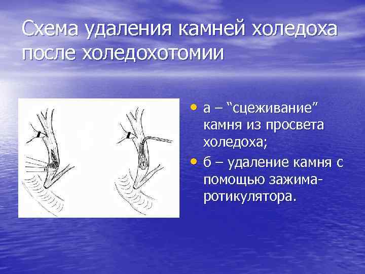 Схема удаления камней холедоха после холедохотомии • а – “сцеживание” • камня из просвета