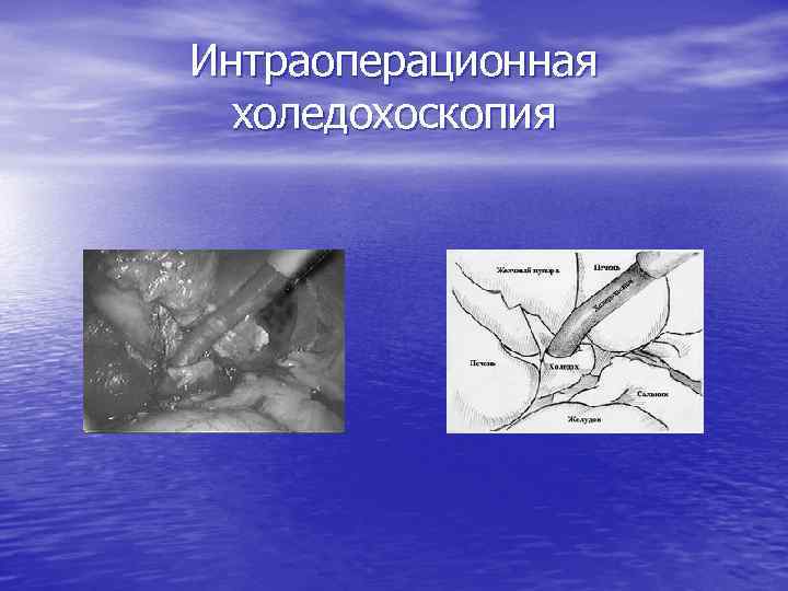 Интраоперационная холедохоскопия 