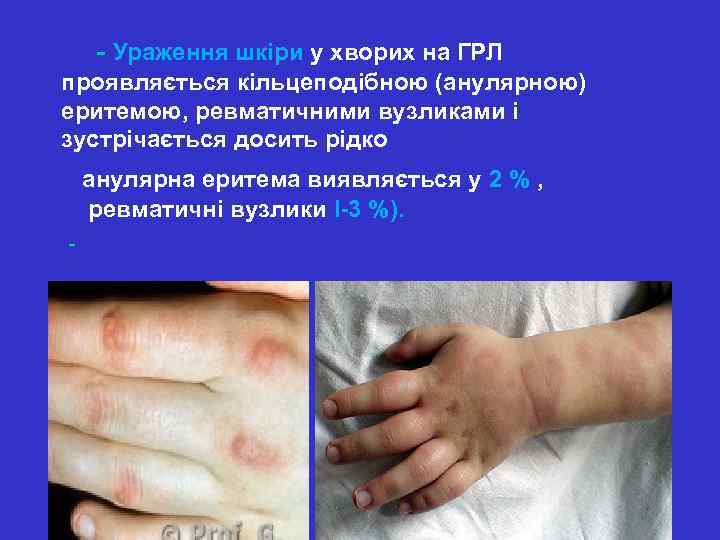  - Ураження шкіри у хворих на ГРЛ проявляється кільцеподібною (анулярною) еритемою, ревматичними вузликами