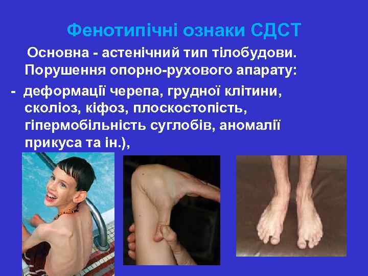 Фенотипічні ознаки СДСТ Основна - астенічний тип тілобудови. Порушення опорно-рухового апарату: - деформації черепа,