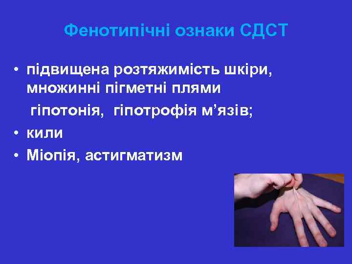Фенотипічні ознаки СДСТ • підвищена розтяжимість шкіри, множинні пігметні плями гіпотонія, гіпотрофія м’язів; •