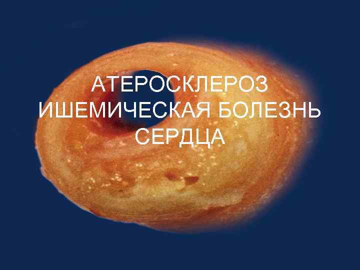 ATЕРОСКЛЕРОЗ ИШЕМИЧЕСКАЯ БОЛЕЗНЬ СЕРДЦА 