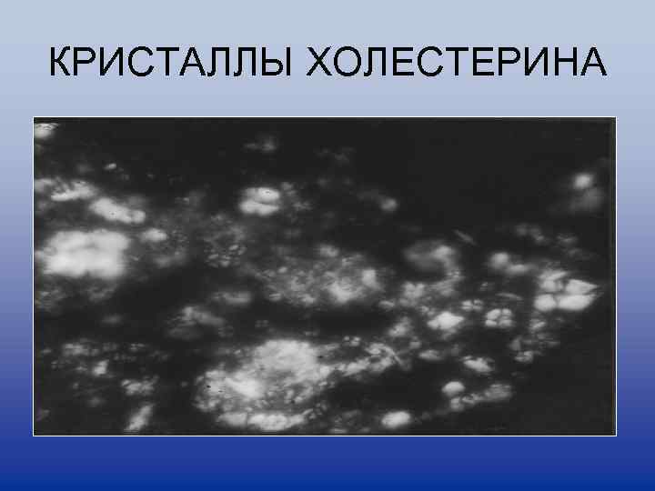 КРИСТАЛЛЫ ХОЛЕСТЕРИНА 