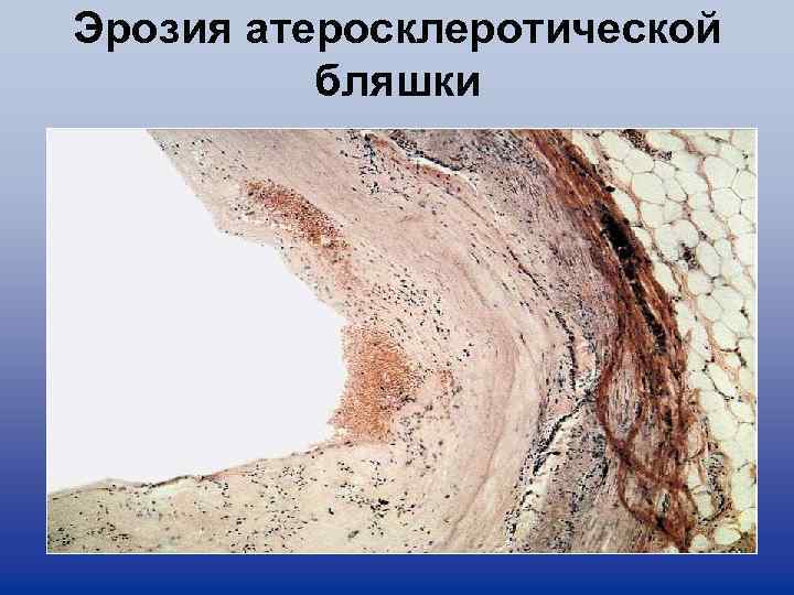 Эрозия атеросклеротической бляшки 