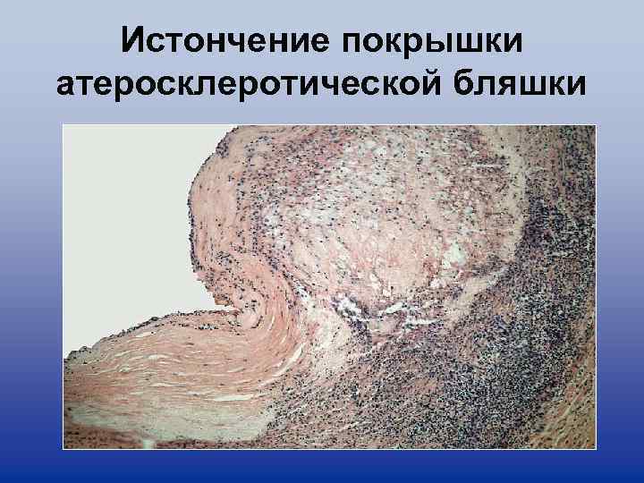 Истончение покрышки атеросклеротической бляшки 