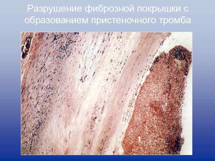 Разрушение фиброзной покрышки с образованием пристеночного тромба 