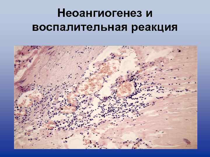 Неоангиогенез и воспалительная реакция 