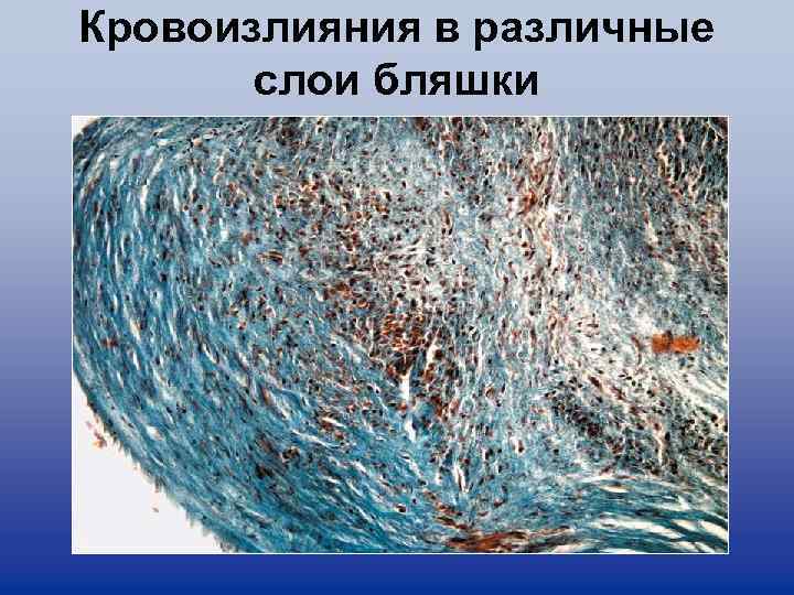 Кровоизлияния в различные слои бляшки 