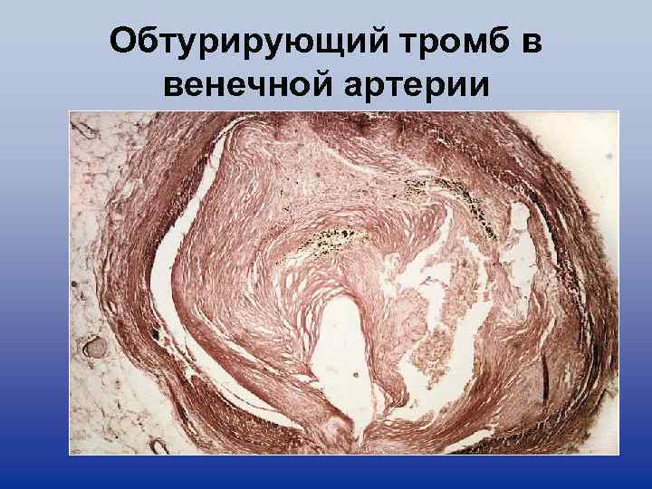 Обтурирующий тромб в венечной артерии 