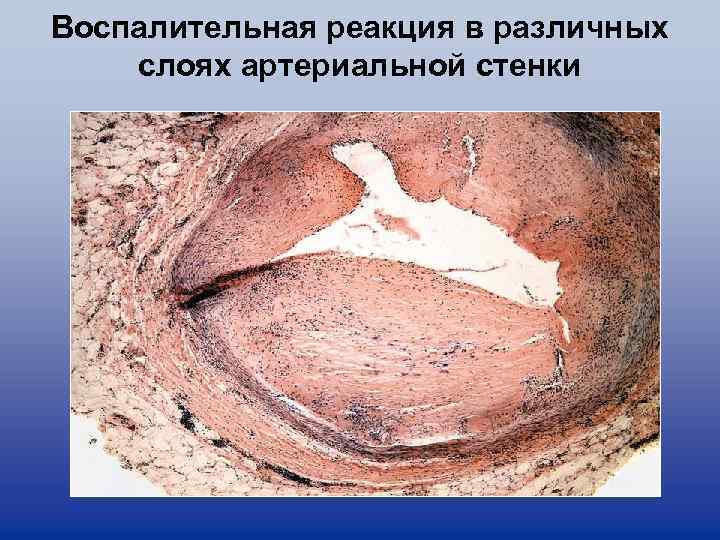 Воспалительная реакция в различных слоях артериальной стенки 