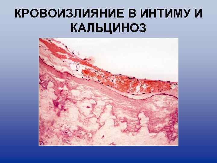 КРОВОИЗЛИЯНИЕ В ИНТИМУ И КАЛЬЦИНОЗ 