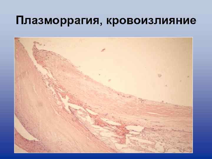 Плазморрагия, кровоизлияние 