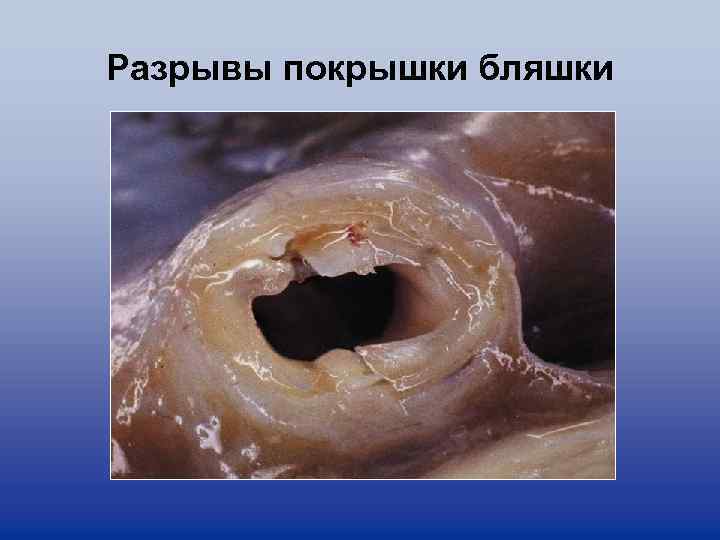 Разрывы покрышки бляшки 