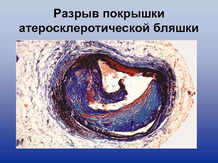 Разрыв покрышки атеросклеротической бляшки 