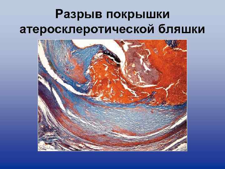 Разрыв покрышки атеросклеротической бляшки 