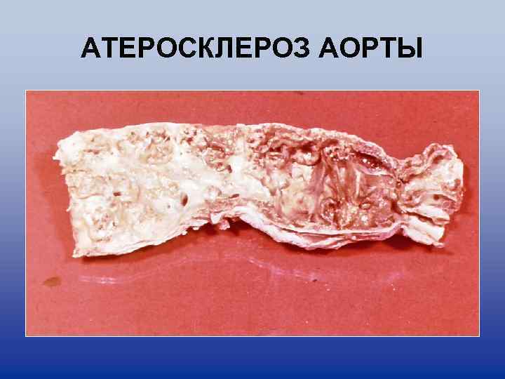 AТЕРОСКЛЕРОЗ АОРТЫ 