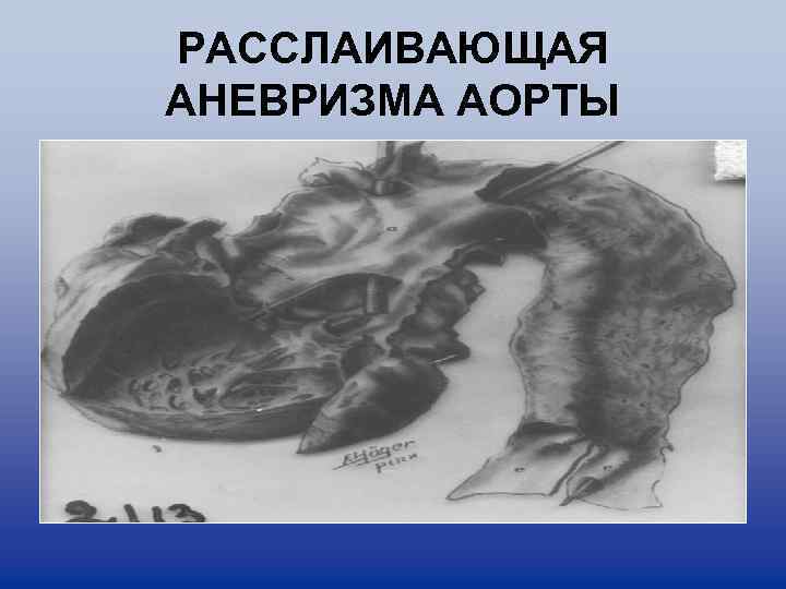 РАССЛАИВАЮЩАЯ АНЕВРИЗМА АОРТЫ 