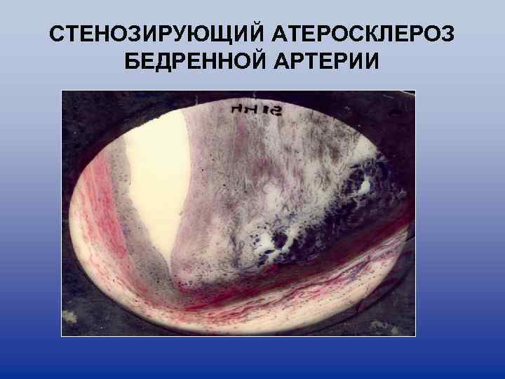 СТЕНОЗИРУЮЩИЙ АТЕРОСКЛЕРОЗ БЕДРЕННОЙ АРТЕРИИ 