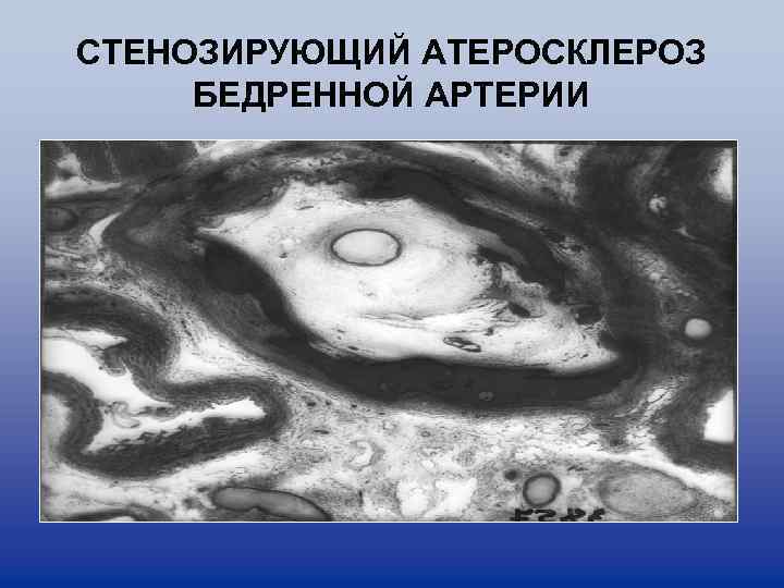 СТЕНОЗИРУЮЩИЙ АТЕРОСКЛЕРОЗ БЕДРЕННОЙ АРТЕРИИ 
