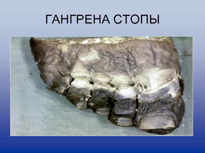 ГАНГРЕНА СТОПЫ 