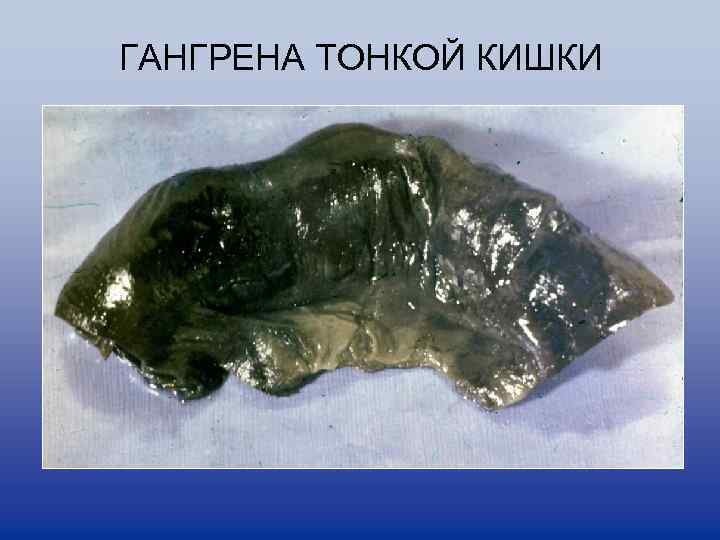 ГАНГРЕНА ТОНКОЙ КИШКИ 