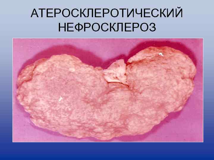 АТЕРОСКЛЕРОТИЧЕСКИЙ НЕФРОСКЛЕРОЗ 