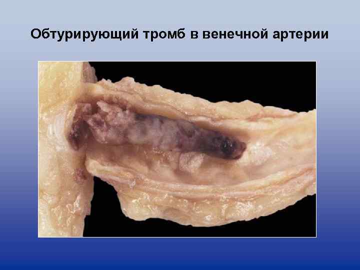 Обтурирующий тромб в венечной артерии 