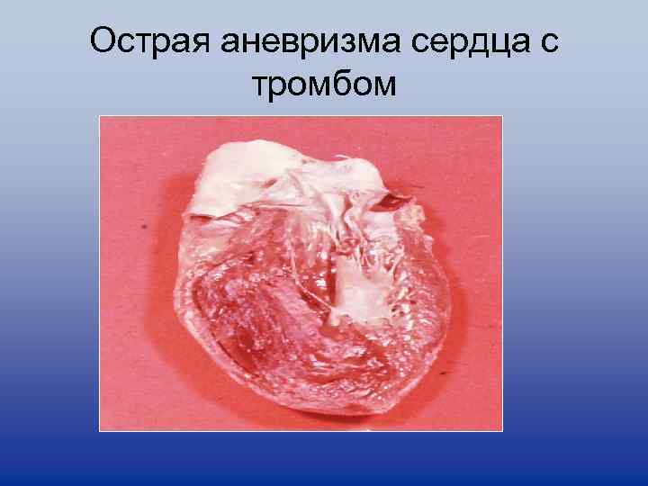Острая аневризма сердца с тромбом 