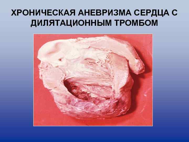 ХРОНИЧЕСКАЯ АНЕВРИЗМА СЕРДЦА С ДИЛЯТАЦИОННЫМ ТРОМБОМ 