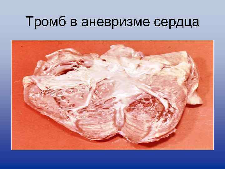 Тромб в аневризме сердца 