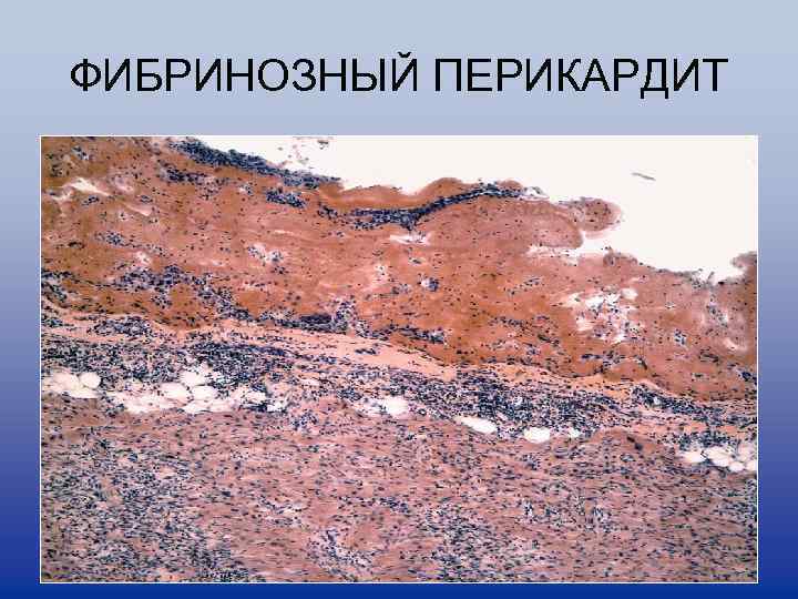 ФИБРИНОЗНЫЙ ПЕРИКАРДИТ 