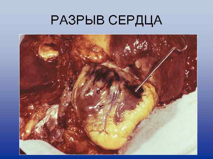 РАЗРЫВ СЕРДЦА 