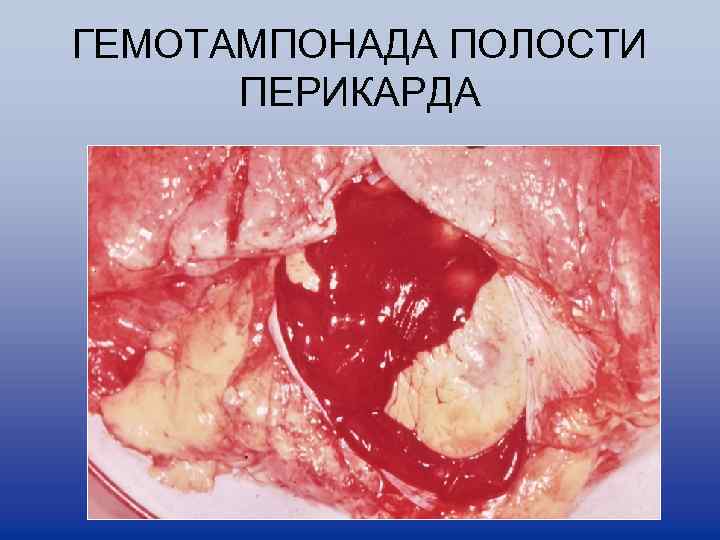 ГЕМОТАМПОНАДА ПОЛОСТИ ПЕРИКАРДА 
