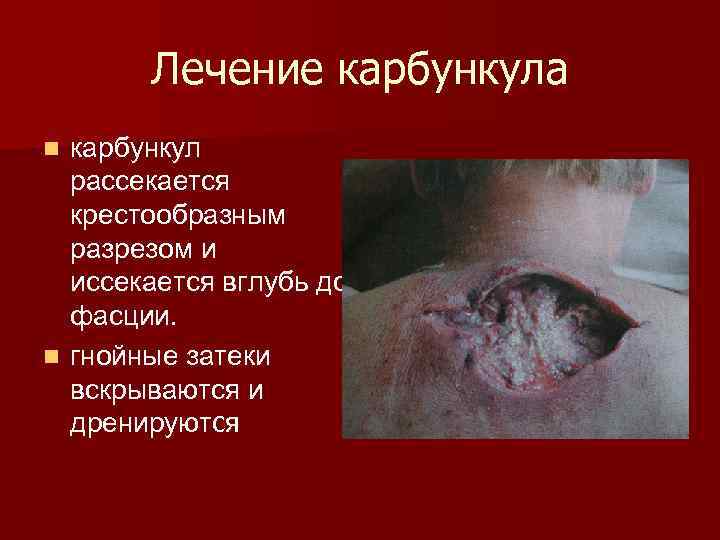 Лечение карбункула карбункул рассекается крестообразным разрезом и иссекается вглубь до фасции. n гнойные затеки