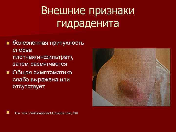 Внешние признаки гидраденита болезненная припухлость сперва плотная(инфильтрат), затем размягчается n Общая симптоматика слабо выражена