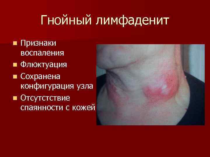 Гнойный лимфаденит n n Признаки воспаления Флюктуация Сохранена конфигурация узла Отсутстствие спаянности с кожей