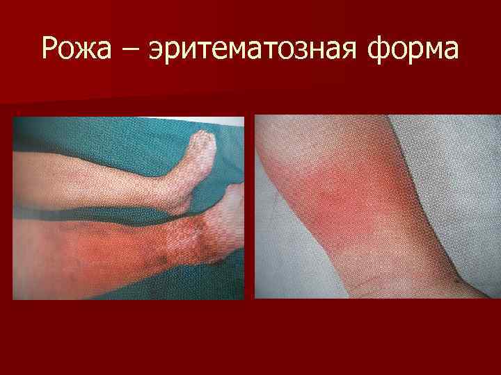 Рожа – эритематозная форма 