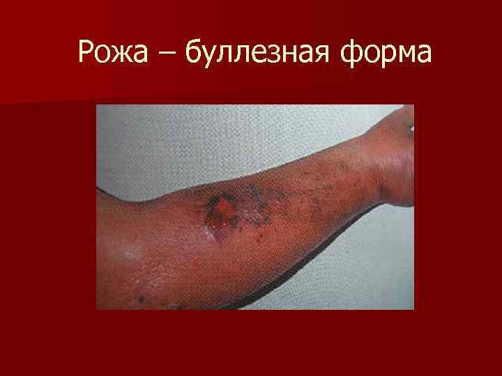 Рожа – буллезная форма 