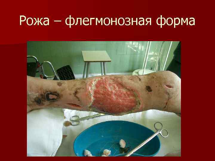 Рожа – флегмонозная форма 