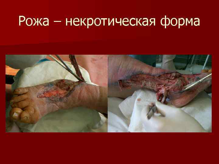 Рожа – некротическая форма 