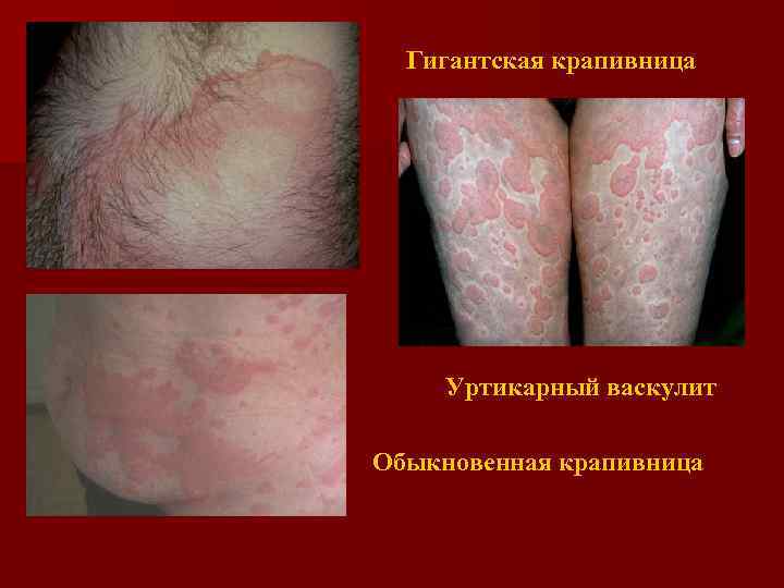 Гигантская крапивница Уртикарный васкулит Обыкновенная крапивница 