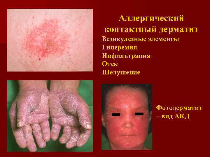 Аллергический контактный дерматит Везикулезные элементы Гиперемия Инфильтрация Отек Шелушение Фотодерматит – вид АКД 