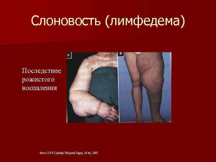 Слоновость (лимфедема) Последствие рожистого воспаления Фото J S P Lumley/ Physical Signs, 18 ed,