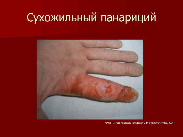 Сухожильный панариций Фото – Атлас «Гнойная хирургия» С. В. Горюнов с соавт, 2004 