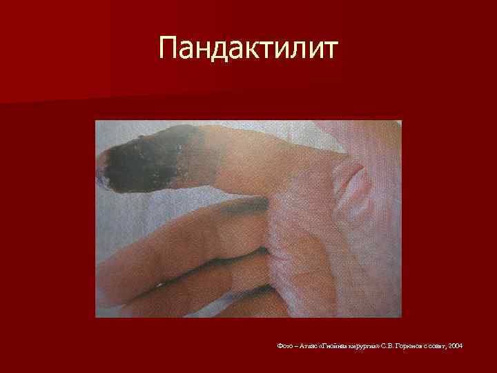 Пандактилит Фото – Атлас «Гнойная хирургия» С. В. Горюнов с соавт, 2004 