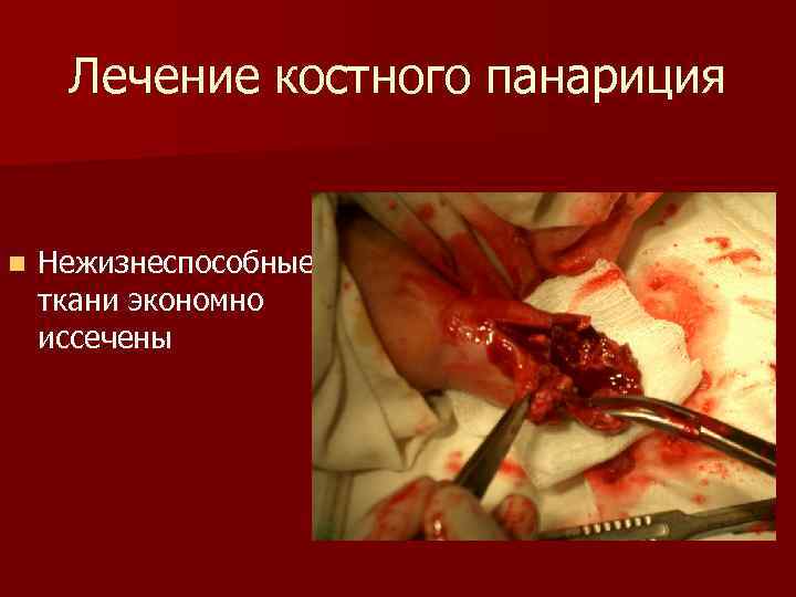Лечение костного панариция n Нежизнеспособные ткани экономно иссечены 