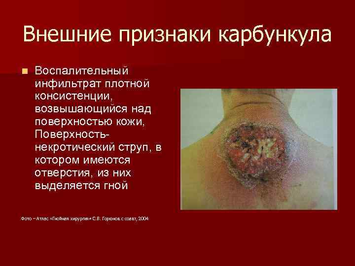 Внешние признаки карбункула n Воспалительный инфильтрат плотной консистенции, возвышающийся над поверхностью кожи, Поверхность некротический