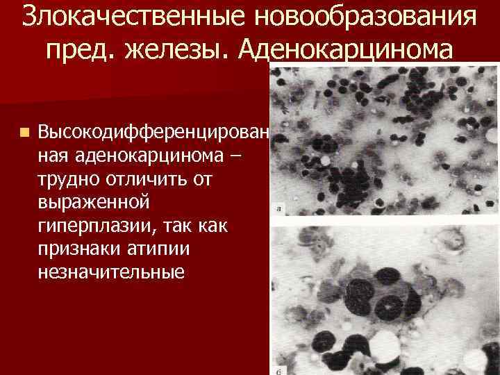 Злокачественные новообразования пред. железы. Аденокарцинома n Высокодифференцирован ная аденокарцинома – трудно отличить от выраженной