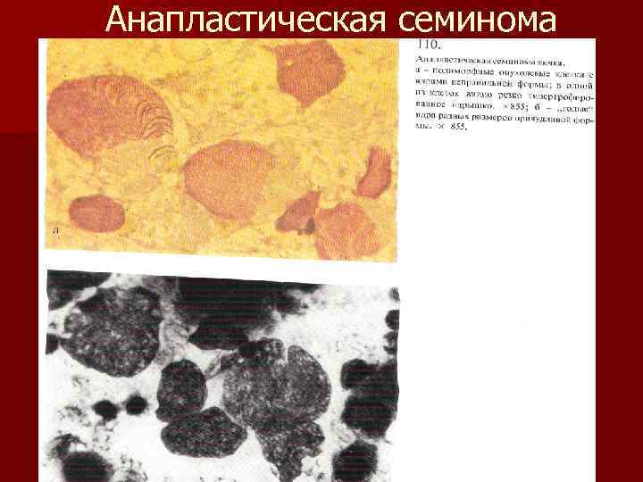 Анапластическая семинома 