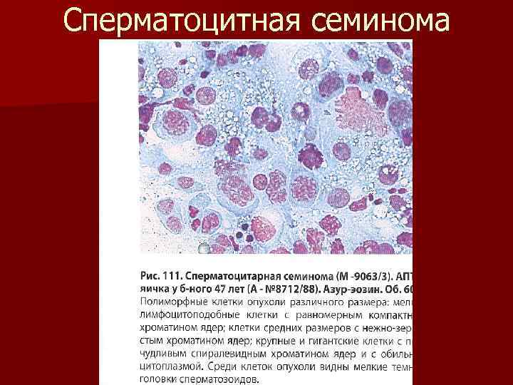 Сперматоцитная семинома 